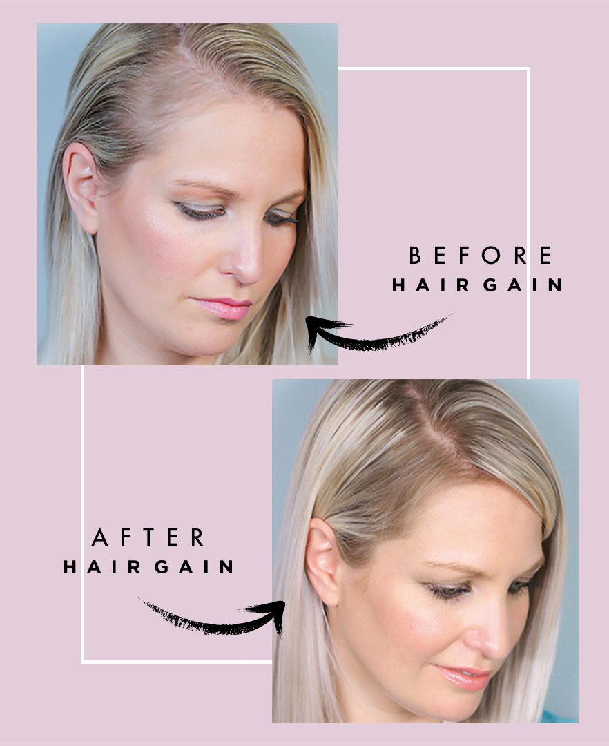 Hair Gain Headmasters